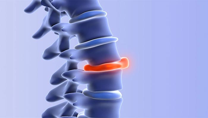 tecnicas de bloqueio nervoso para controle da dor na hernia de disco